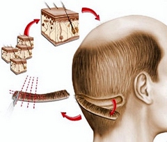 ოპერაციული (ზონრის) მეთოდი - FUT/ STRIP (Follicular Unit Transplant)