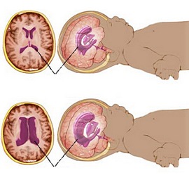ფეხმძიმობის მე-19 კვირა - ჰიდროცეფალია